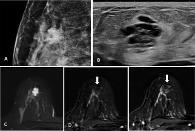 Case Report: Mucocele-Like Tumor of the Breast Associated With Ductal Carcinoma In Situ